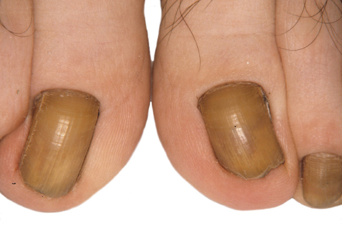 Unlocking the Mystery of Yellow Nail Syndrome | Homeo Care Clinic, Pune
