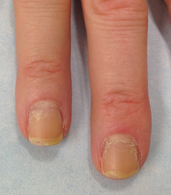 Nail Psoriasis: Causes, Pictures and Treatments