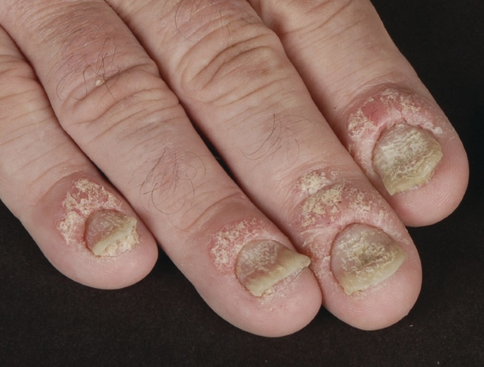 Recommendations for the definition, evaluation, and treatment of nail  psoriasis in adult patients with no or mild skin psoriasis: A dermatologist  and nail expert group consensus - ScienceDirect