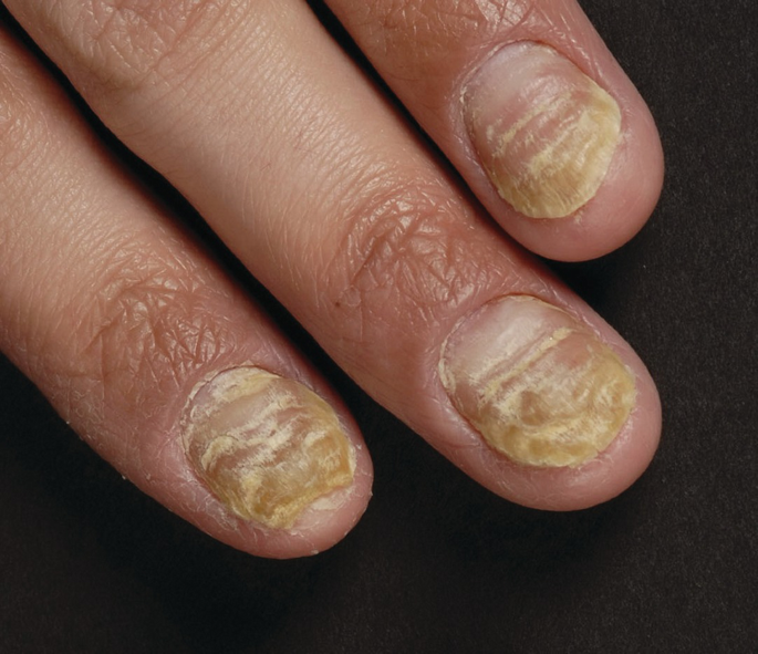 Latest Research in Nail Psoriasis | SpringerLink