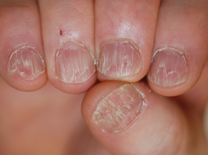 Inflammatory nail conditions. Part 2: nail changes in lichen planus and  alopecia areata