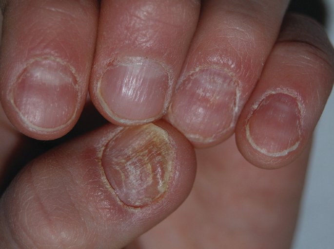 Nail Lichen Planus | SpringerLink