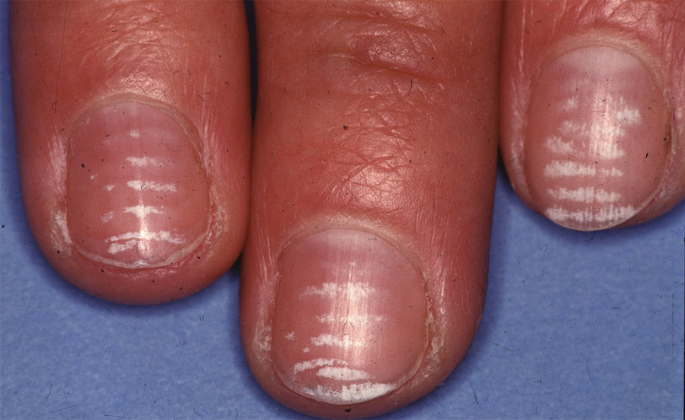 Hi, Does this look like nail fold changes linked to scleroderma to you? I  have positive antibodies and a ton of symptoms but been dismissed by  reumatologist. : r/scleroderma