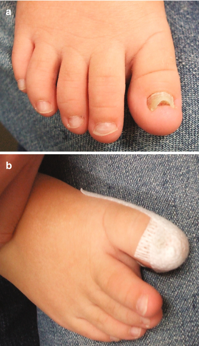 Pincer Nail Deformity Associated with Systemic Lupus Erythematosus