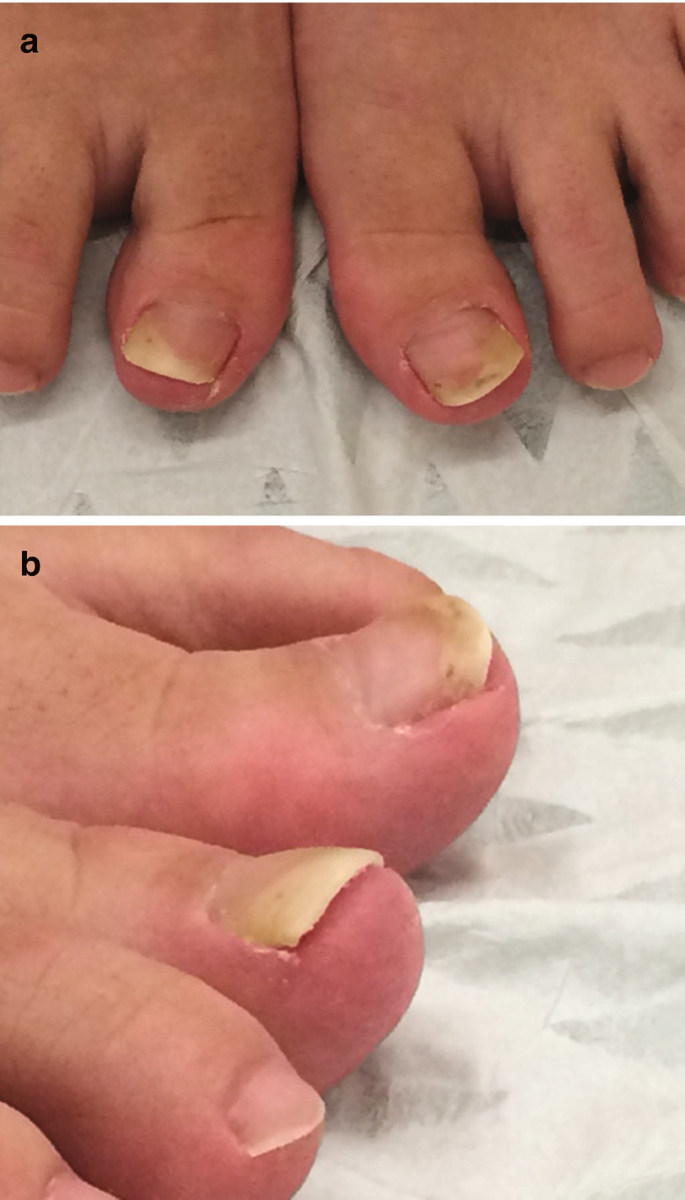 Great Toenail Dystrophy: A Single-Center Experience and Review of the  Literature