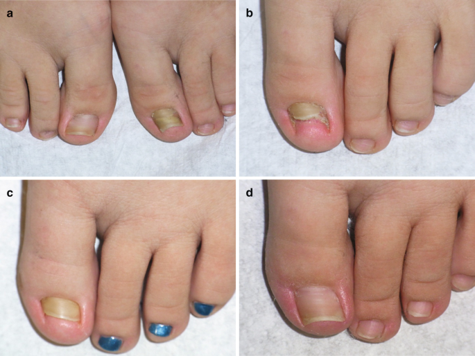 Ingrown toenails - Indian Journal of Dermatology, Venereology and Leprology