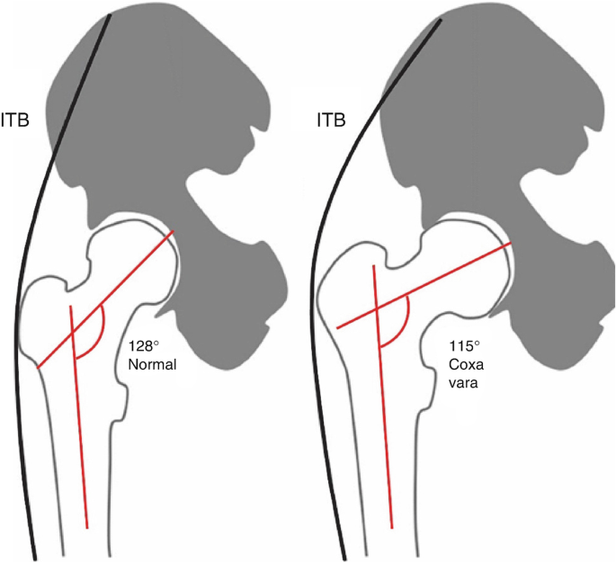 Trochanteric Bursectomy Lee's Summit, Trochanteric Bursitis