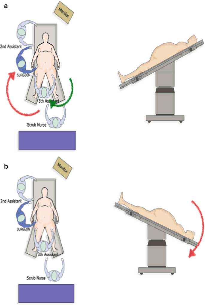 Laparoscopic One Anastomosis Gastric Bypass (OAGB)/Mini Gastric 