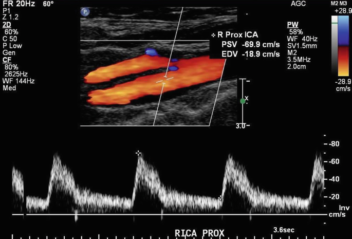 Color Duplex Scanning of the Extracranial Carotid Arteries | SpringerLink