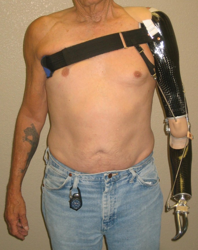 Body-Powered Prosthetic Systems