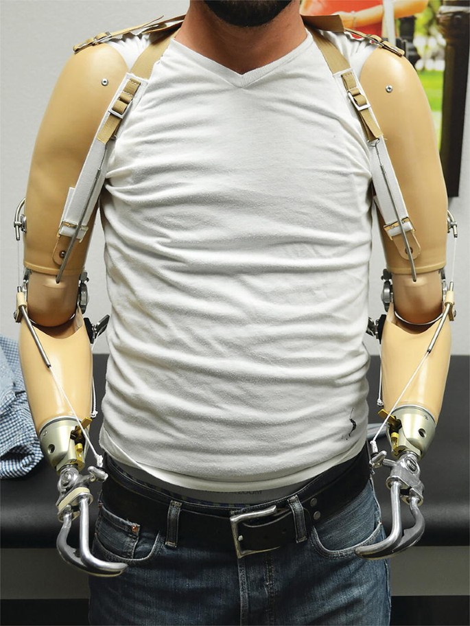 Body-Powered Prosthetic Systems