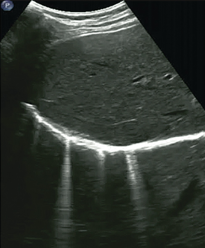 Common Ultrasound Artefacts - RCEMLearning India