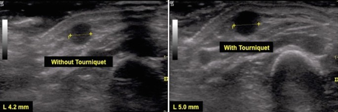 Doppler vascular mapping in Arterio Venous Fistula (AVF)