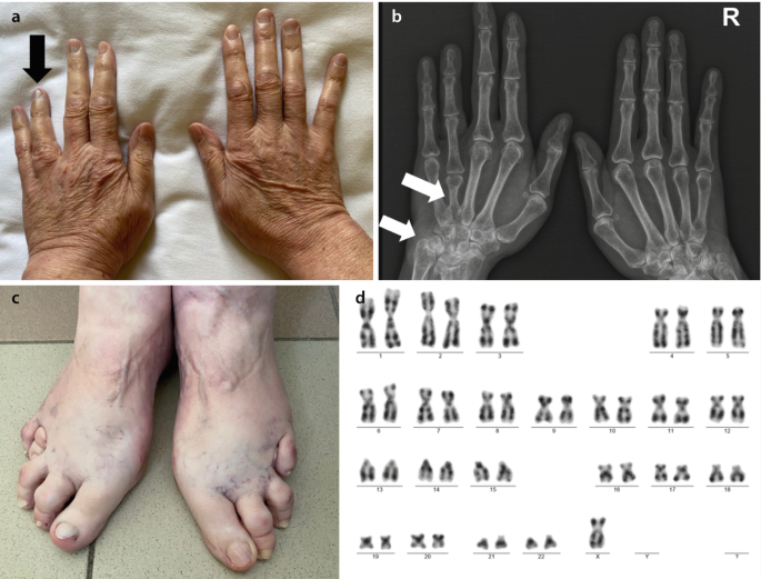 Turner Syndrome-Types-Diagnosis-Homeopathic-Allopathic-Treatment-Dr-Qaisar-Ahmed-Risalpur-KPK-Pakistan