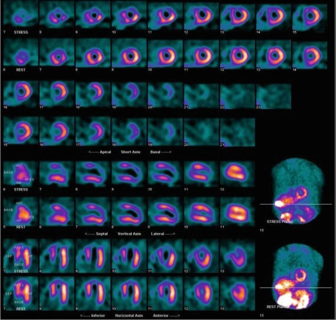 Assessment of Myocardial Viability Using Nuclear Medicine Imaging in  Dextrocardia