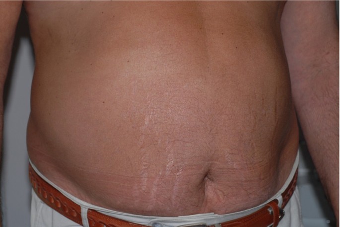 Grossly distended abdomen with full flanks and visible striae