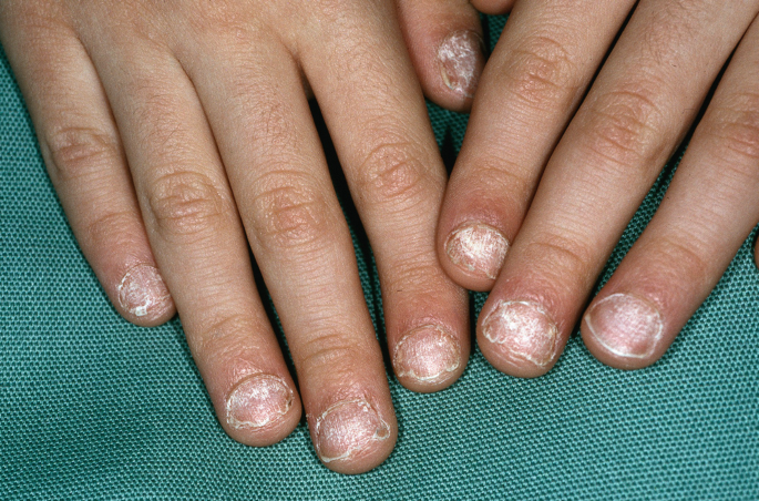Pediatric Nail Disorders and Selected Genodermatoses with Nail Findings |  SpringerLink