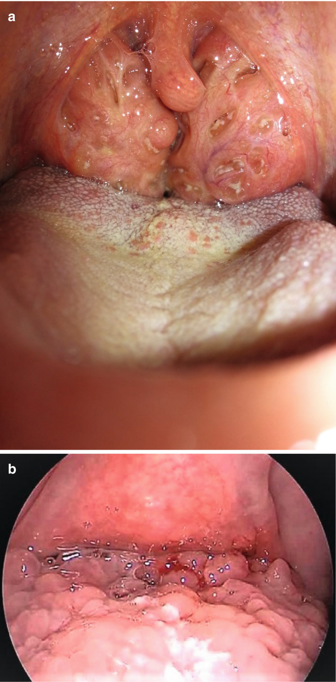 lingual tonsil bumps