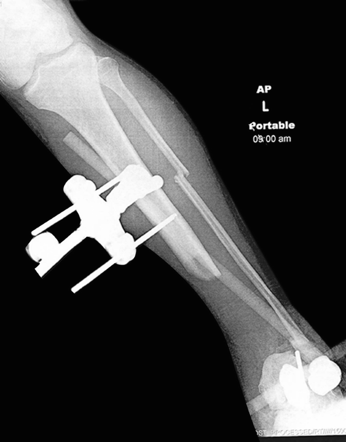 Tibia Fractures: Ilizarov / Circular Wire Fixators : Wheeless' Textbook of  Orthopaedics