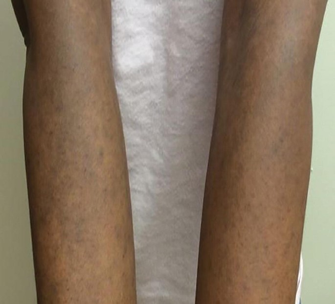 Rippled Macules and Papules on the Legs