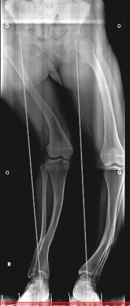 Limb Deformity | SpringerLink