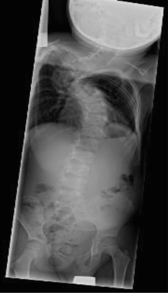 Paediatric Sacral Wedge