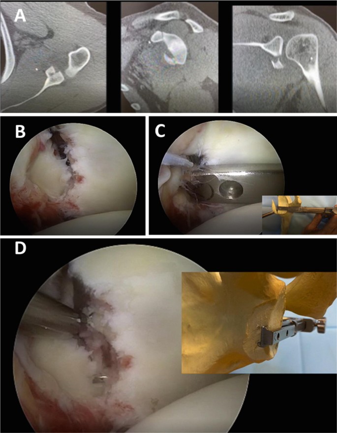 Glenoid Fracture 