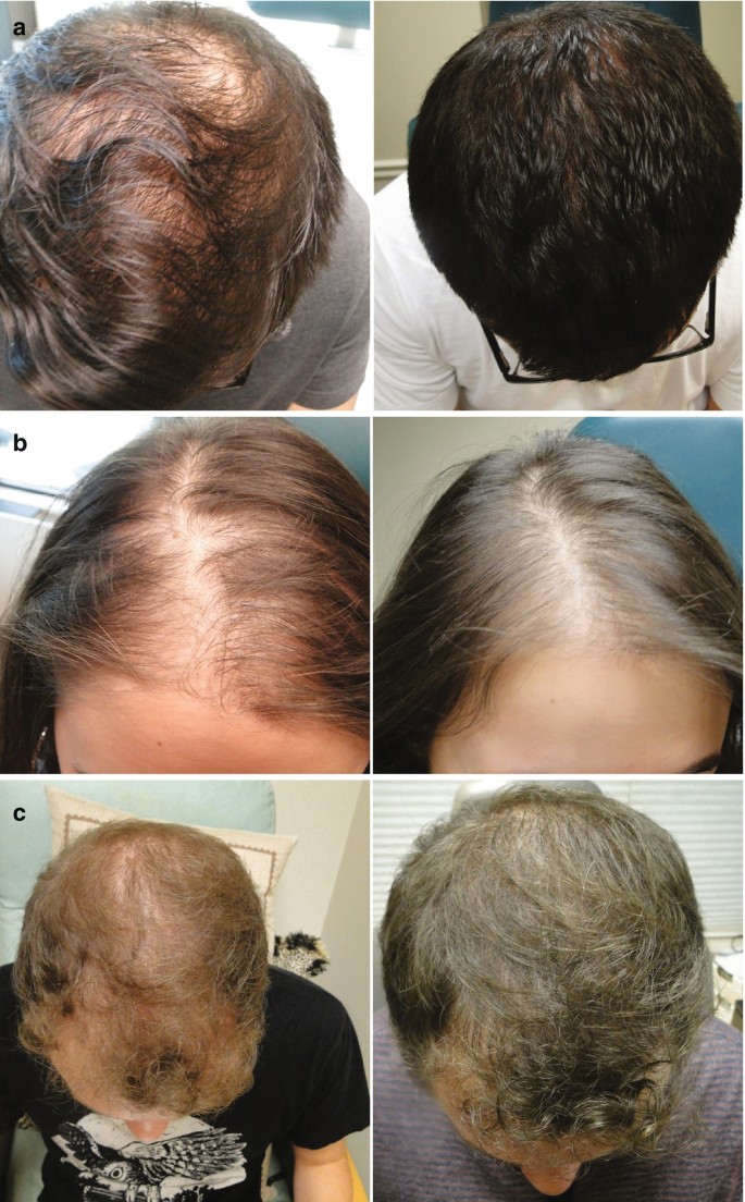 Platelet-Rich Plasma for Hair Loss | SpringerLink Platelet-Rich Plasma for Hair Loss | SpringerLink
