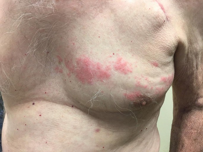 68-Year-Old Male with Intense Itching Followed by Blisters on the Breast