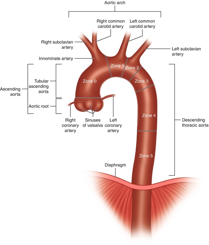 Aortic Anatomy And The Pathophysiology Of Acute Aortic Syndromes Springerlink