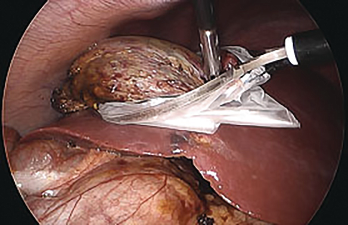Laparoscopic Gallbladder Removal Surgery Zip Pouch by Laparoscopy Surgery -  Fine Art America