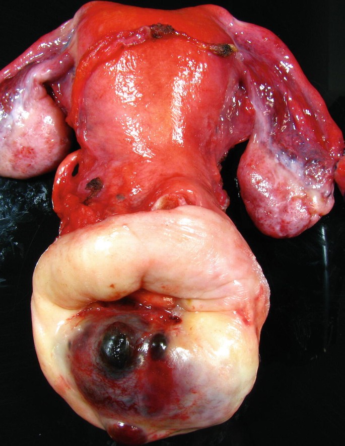 Gross photographs from the cervix of a 40 year old premenopausal HNW