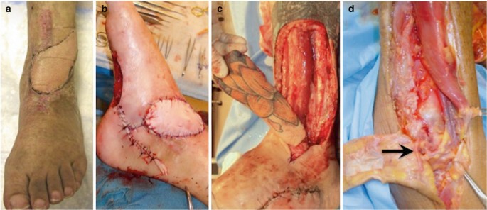 Managing Wound-Healing Complications After Total Ankle Replacement