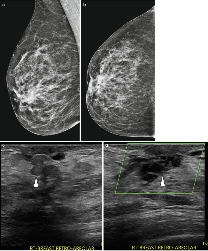 Clinical abnormalities of the nipple-areola complex: The role of