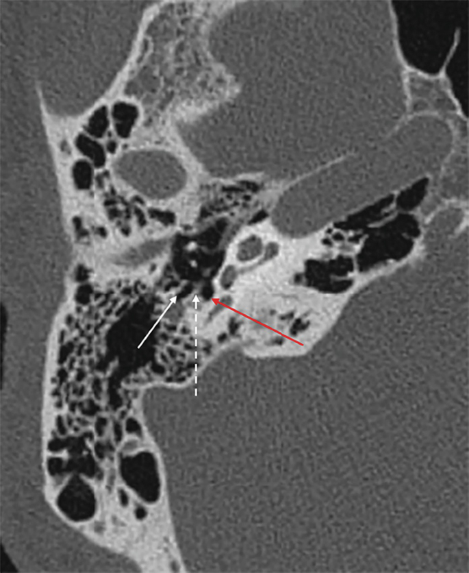 pyramidal eminence ct