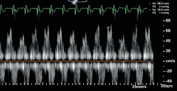 Pericarditis "Pericardial