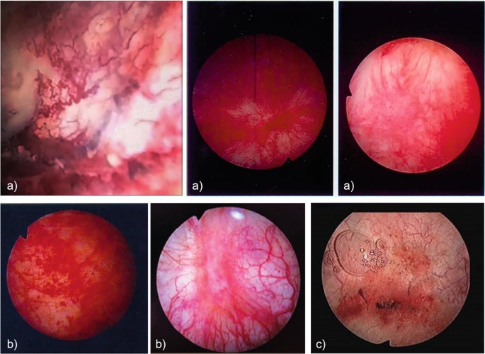 Endoscopic Evaluation | Springer Nature Link