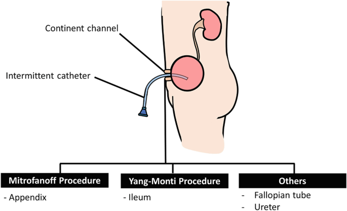 Flank pain, haematuria and poor patient compliance: beware the 'forgotten'  JJ stent!