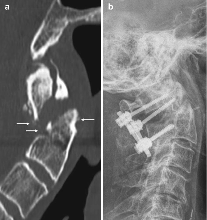 Odontoid and hangman fracture