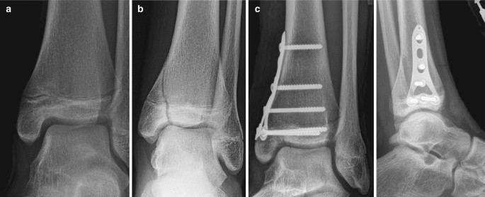 Acute Fractures in Sport: Ankle