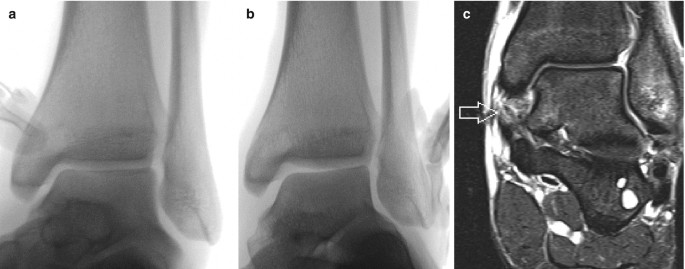 Medial collateral ligament sprain rehabilitation exercises - Document -  Gale OneFile: Health and Medicine