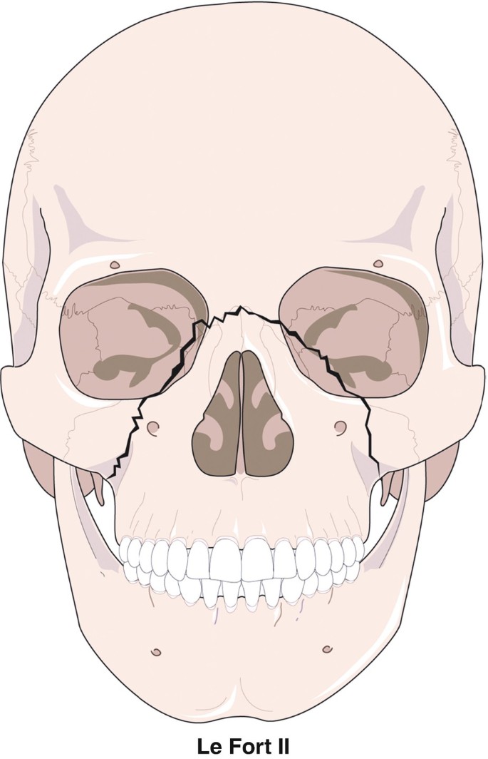 Facial Sutures