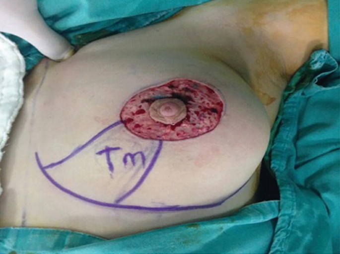 Mammaplasty with L-shaped scar