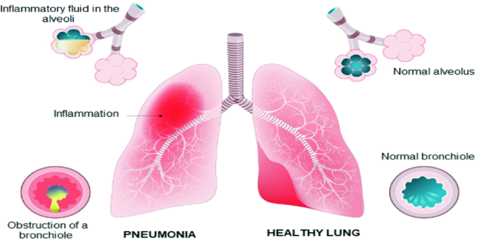Automated Methods for Detection and Classification Pneumonia Based on X-Ray Images Using Deep Learning | SpringerLink Automated Methods for Detection and Classification Pneumonia Based on X-Ray Images Using Deep Learning | SpringerLink