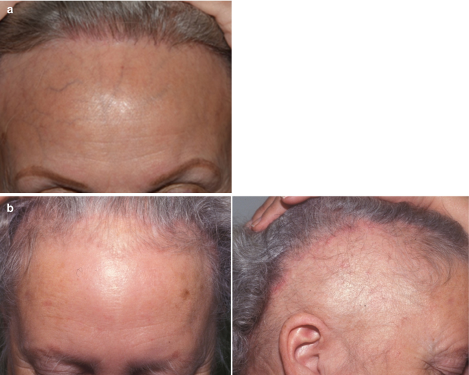 Hair Loss | SpringerLink Hair Loss | SpringerLink