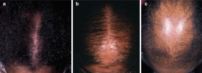 Hair Loss | SpringerLink Hair Loss | SpringerLink