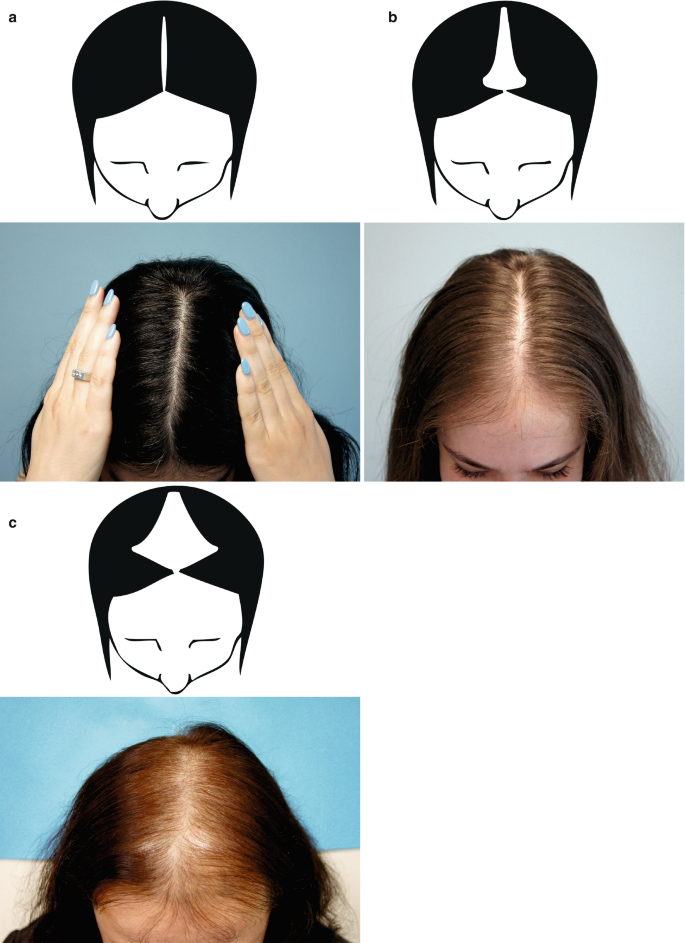 Female pattern hair loss  DermNet