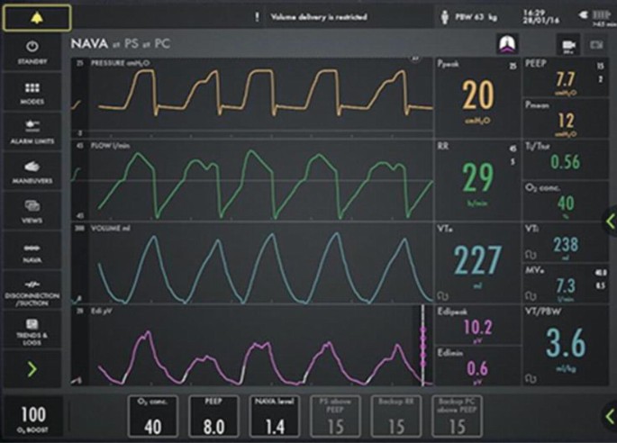 limpiar Pence eterno Ventilatory Modes: Neurally Adjusted Ventilatory Assist (NAVA)/Pressure Support Ventilation/Bi-PAP Mode/Continuous Positive Airway Pressure | SpringerLink limpiar Pence eterno Ventilatory Modes: Neurally Adjusted Ventilatory Assist (NAVA)/Pressure Support Ventilation/Bi-PAP Mode/Continuous Positive Airway Pressure | SpringerLink