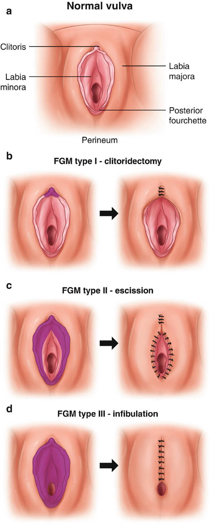 Fat Grafting and Adipose Stem Cells to Treat Vulvar Scarring and