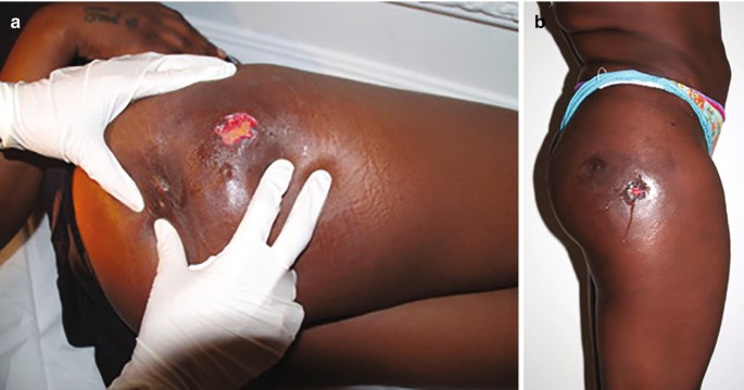 Complications in Regenerative and Fat Transfer Surgery: Pathophysiology and  Management with Technical Tips to Reduce Risk | SpringerLink